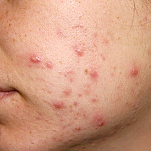 Acne huidtherapie