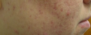 Acne huidtherapie