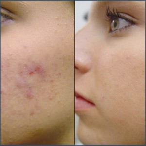 Acne therapie huidtherapie